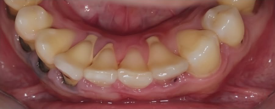 Before Oral Prophylaxis